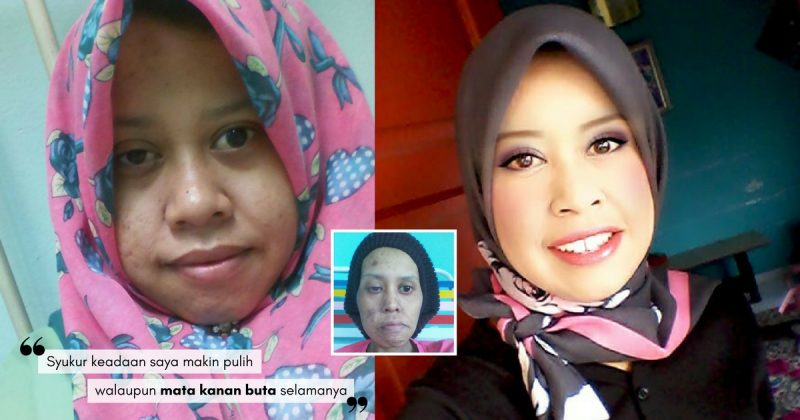 Menderita KANSER HIDUNG Selepas Berpantang, Wanita Ini 